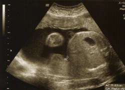 Fetal anomaly scan