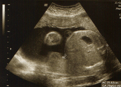 Pregnancy Scan - Fetal anomaly scan Pregnancy Scan - Fetal anomaly scan