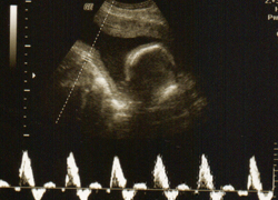 Vasa Praevia Screening Vasa Praevia Screening